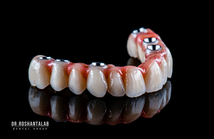 روکش تمام سرامیک