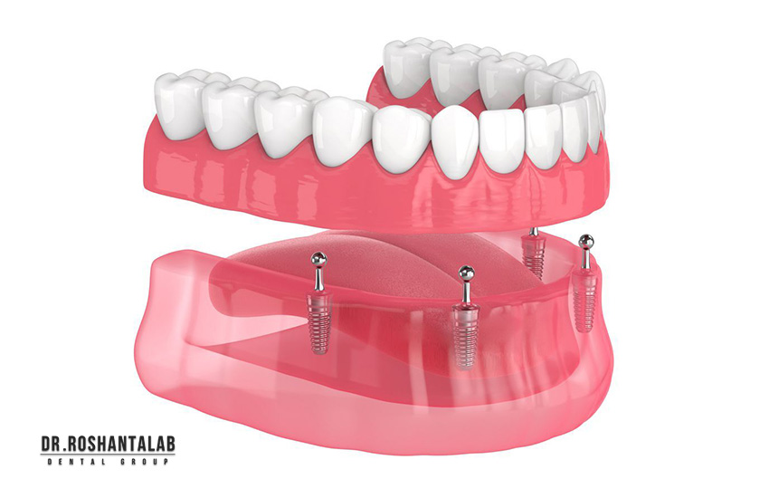 مینی ایمپلنت دندان چیست؟ 5 مزیت که دندان مصنوعی را نابود کرد!