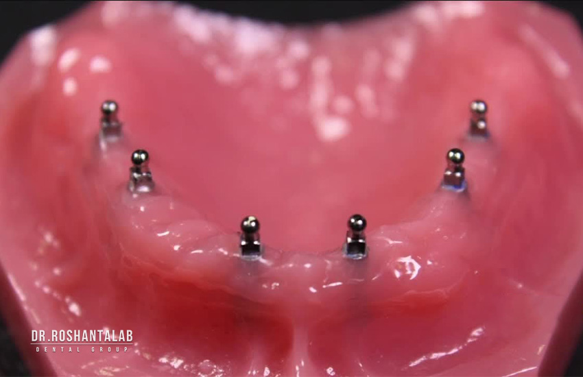 مینی ایمپلنت