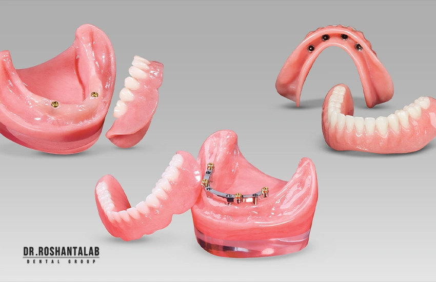 اوردنچر متکی بر ایمپلنت (Overdenture)