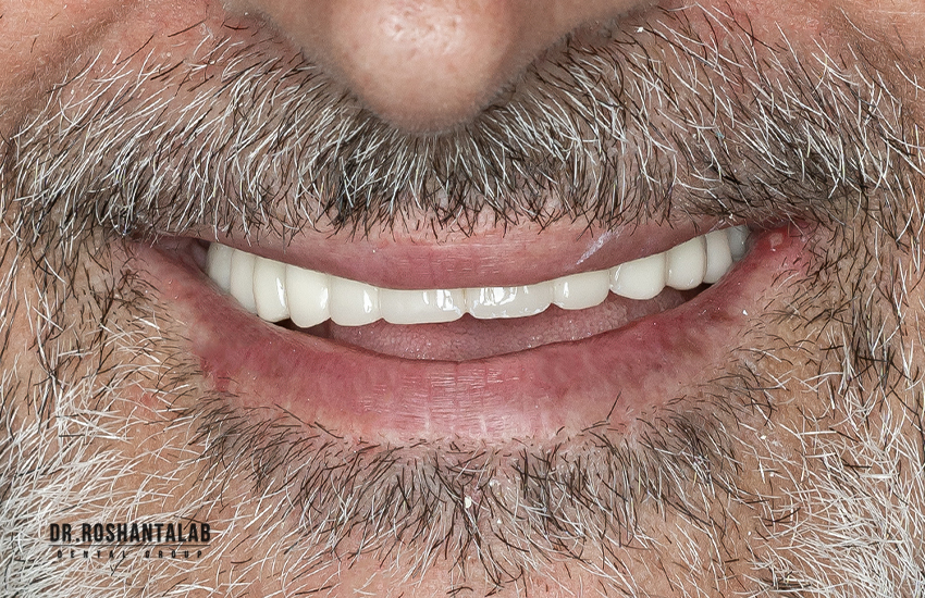 مزایای ایمپلنت دندان با بیهوشی