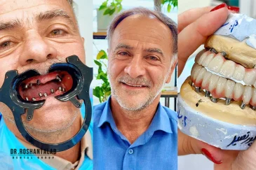 انواع ایمپلنت دندان: 3 مدلی که هرگز نباید انتخاب کنید!