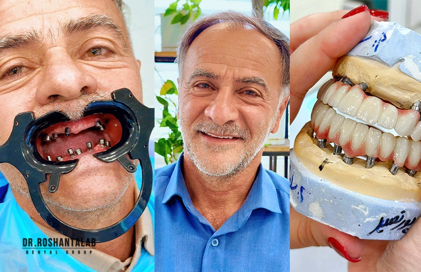 انواع ایمپلنت دندان: 3 مدلی که هرگز نباید انتخاب کنید!