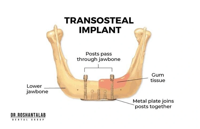 ایمپلنت‌های ترنس‌استیال (Transosteal Implants) 