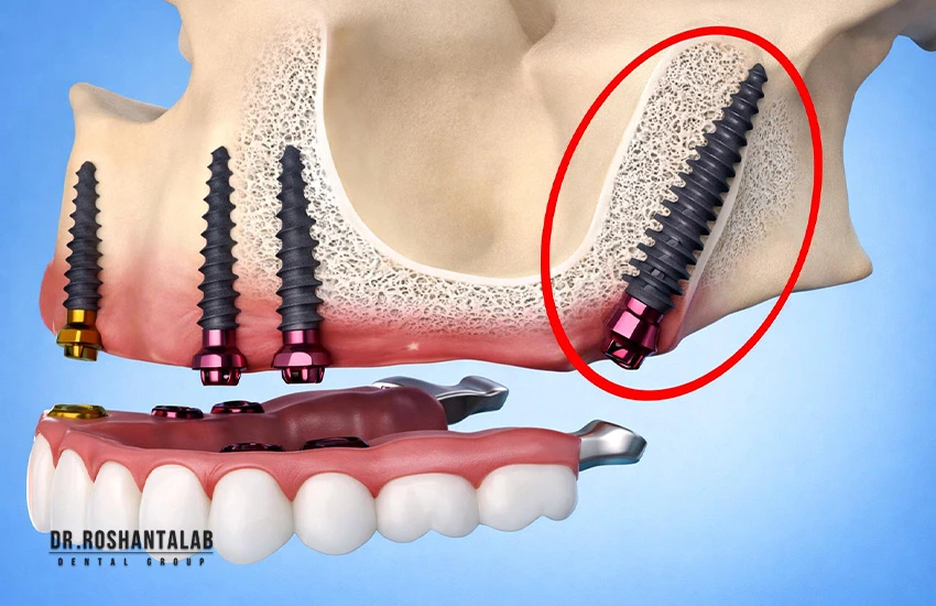  ایمپلنت‌های پتریگوئید (Pterygoid Implants)