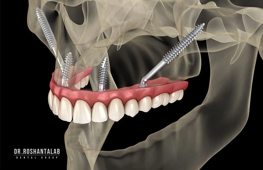 ایمپلنت زایگوماتیک (Zygomatic Implant)