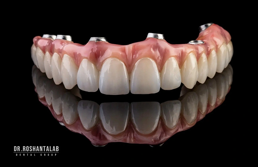انواع روکش ایمپلنت دندان: روکش زیرکونیا ( Zirconia)