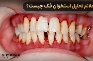 علائم تحلیل استخوان فک