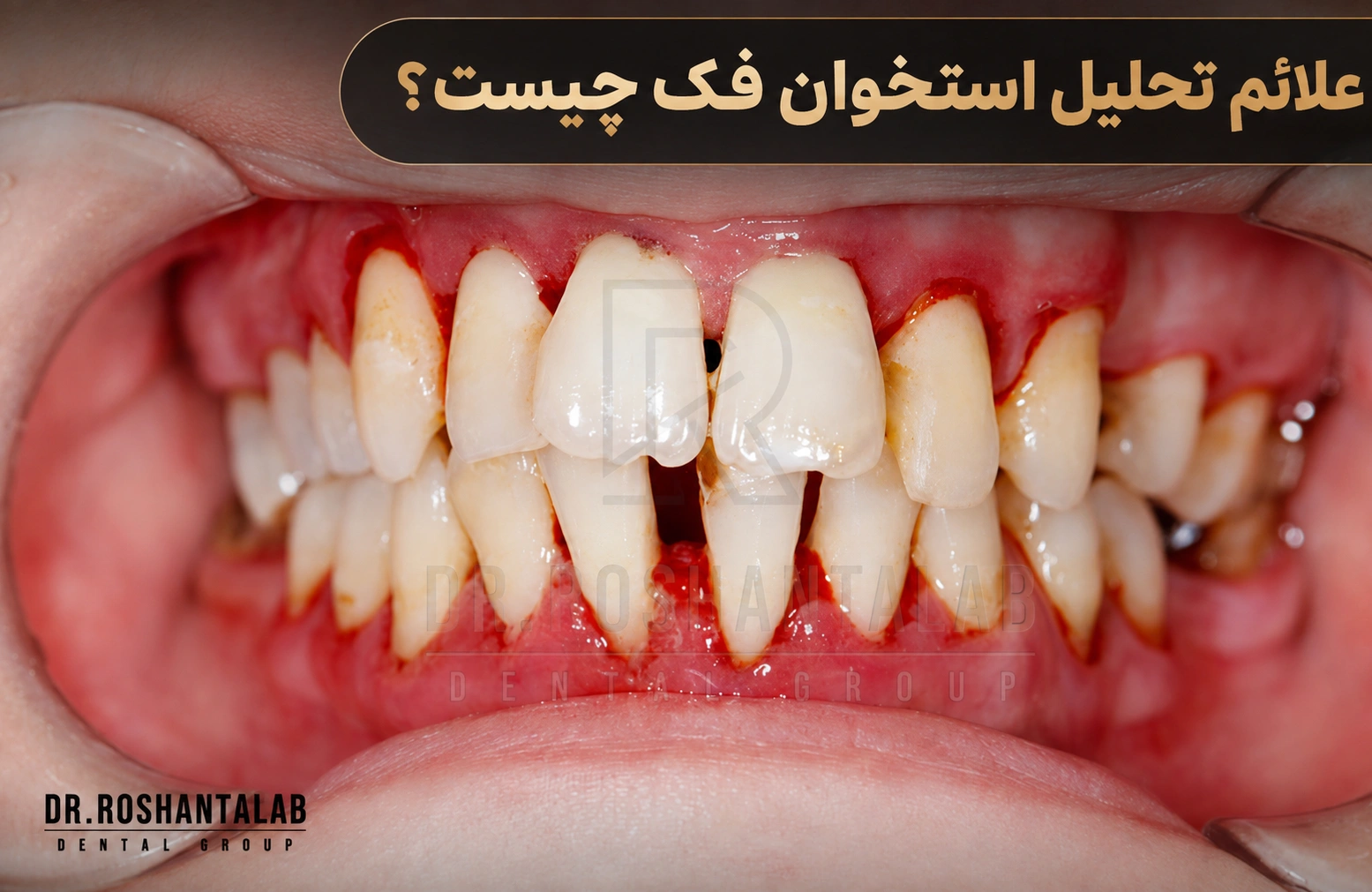 علائم تحلیل استخوان فک