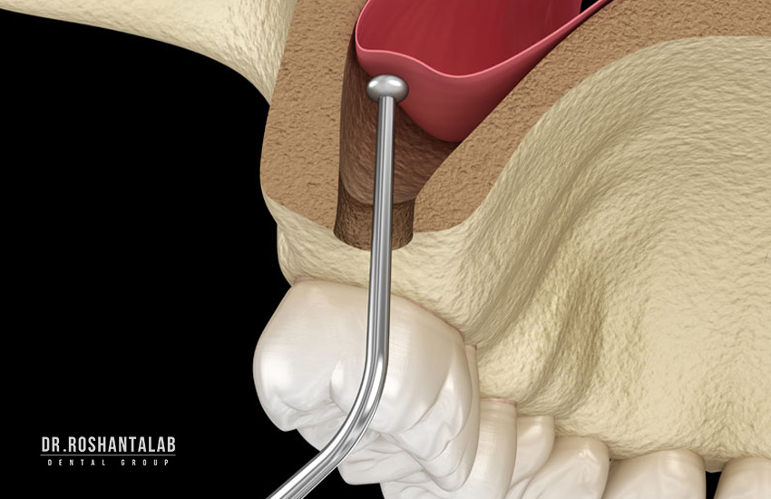 سینوس لیفت در ایمپلنت و پوکی استخوان