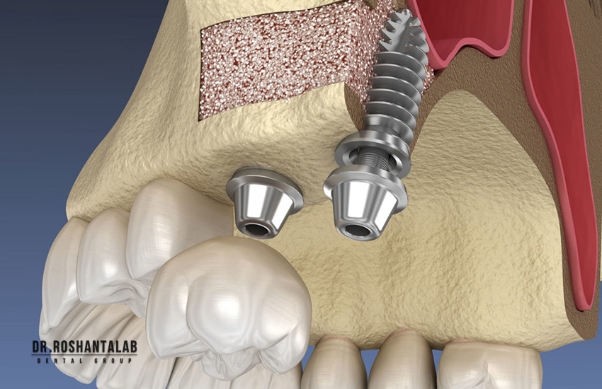 پیوند استخوان در ایمپلنت و پوکی استخوان