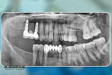 کاشت ایمپلنت توسط دکتر روشن طلب