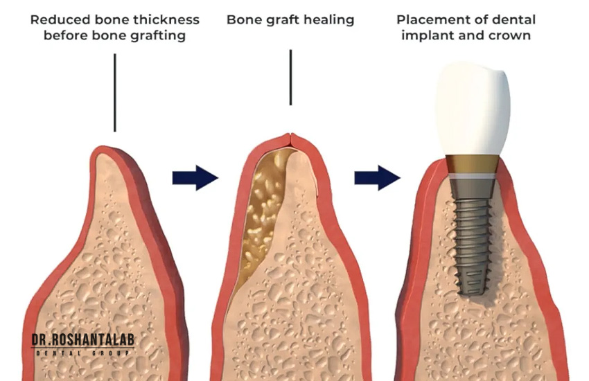 پیوند استخوان در ایمپلنت و پوکی استخوان