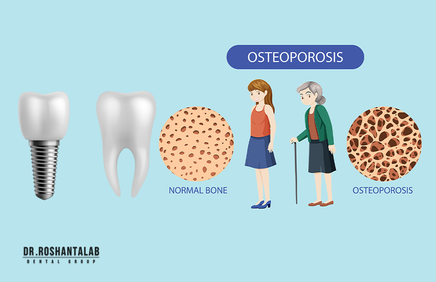 ایمپلنت و پوکی استخوان