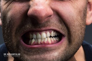 آیا دندان قروچه علت خرابی ایمپلنت است؟