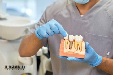 کاشت ایمپلنت دندان برای چه کسانی مناسب نیست