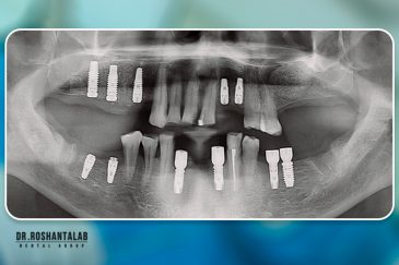 ایمپلنت همزمان با کشیدن دندان