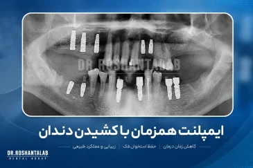 ایمپلنت همزمان با کشیدن دندان