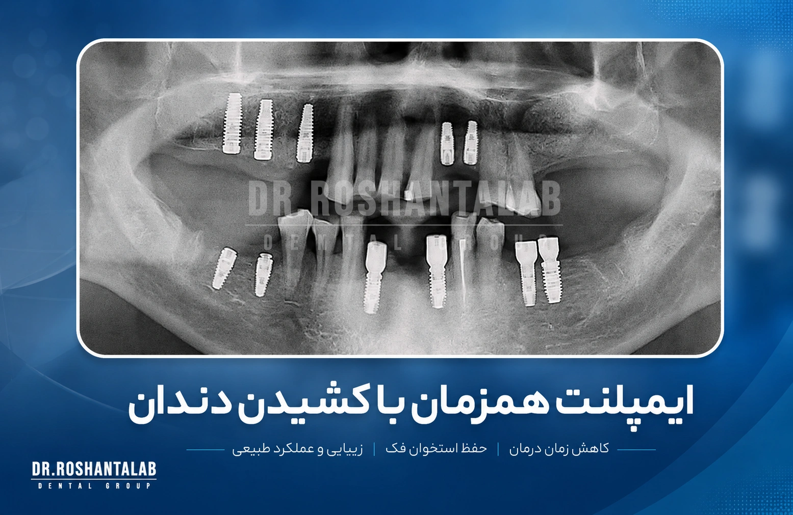ایمپلنت همزمان با کشیدن دندان