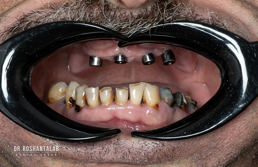 علائم جوش خوردن ایمپلنت دندان