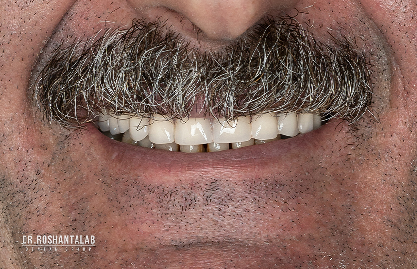 علائم جوش خوردن ایمپلنت دندان