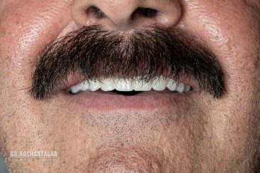 پروتز کامل فک بالاَ