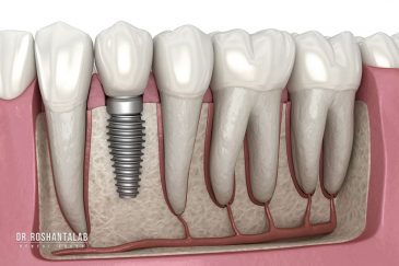 نحوه جوش خوردن ایمپلنت