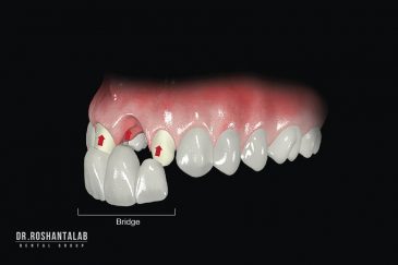 بریج دندان چیست؟ مزایا و معایب آن