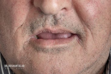 عوارض بی دندانی و راه حل‌ های آن