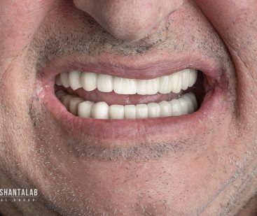 قیمت ایمپلنت کره ای : سال 1404