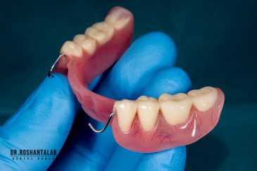 پروتز پارسیل