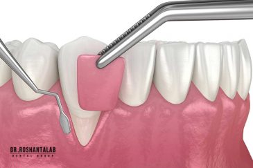 جراحی لثه برای ایمپلنت انجام می‌شود؟ 5 دلیل مهم آن