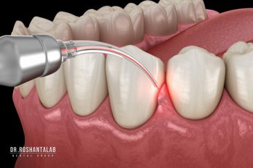 استفاده از لیزر دندانپزشکی