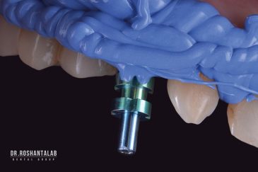 قالب‌گیری ایمپلنت دندان چگونه انجام می‌شود؟