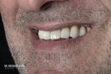 جرم گیری ایمپلنت دندان