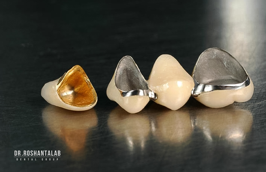مراقبت از روکش دندان و افزایش طول عمر آن - کلینیک تخصصی ایمپلنت رشت - خبرخوان تی شین