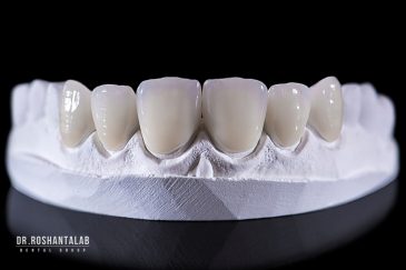 لمینت دندان بهتر است یا روکش؟