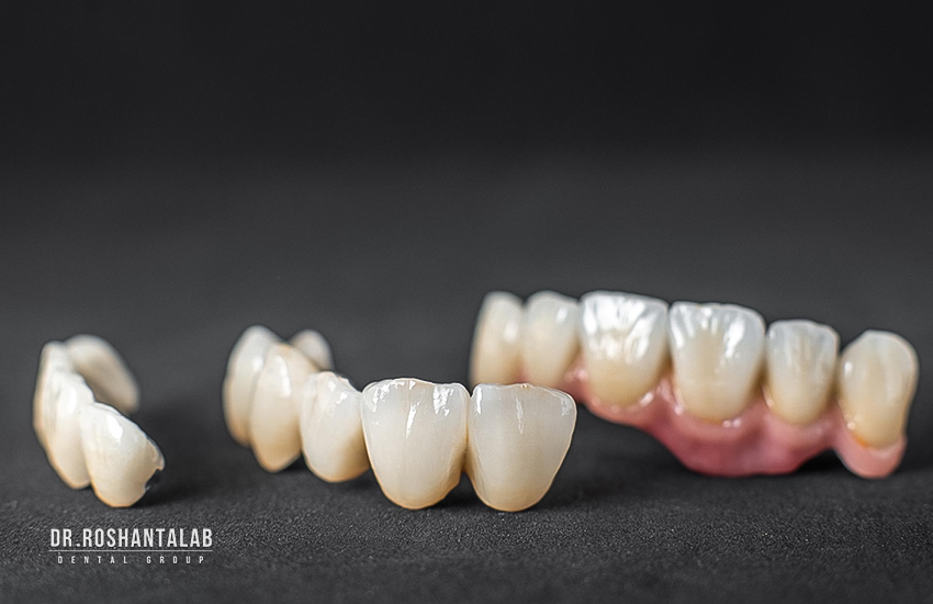 مراقبت از روکش دندان و افزایش طول عمر آن - کلینیک تخصصی ایمپلنت رشت - خبرخوان تی شین