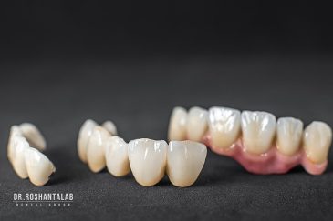 رعایت بهداشت روکش‌ های دندانی و ایمپلنت: 8 نکته مهم