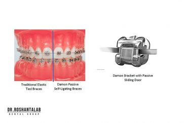 براکت ارتودنسی