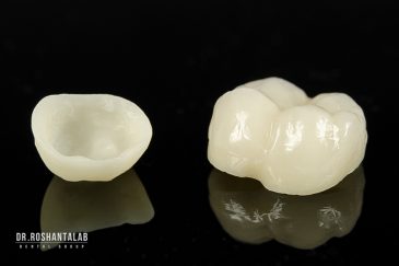 طول عمر روکش دندان چقدر است؟