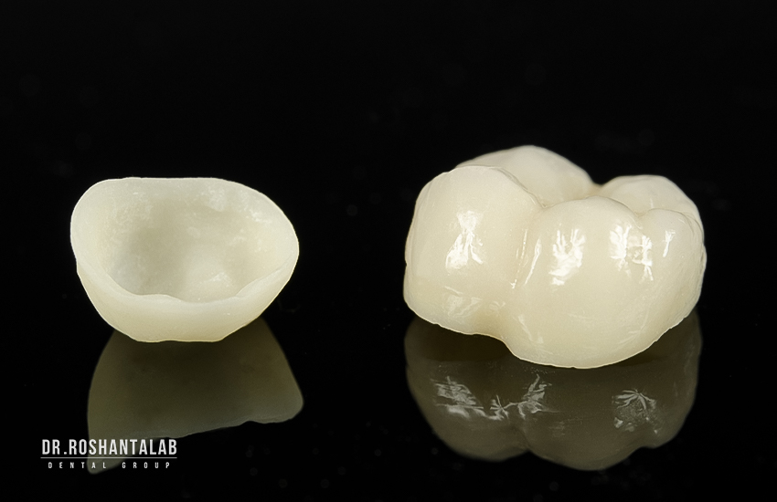 طول عمر روکش دندان چقدر است؟