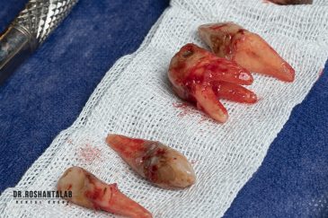 جراحی و کشیدن دندان