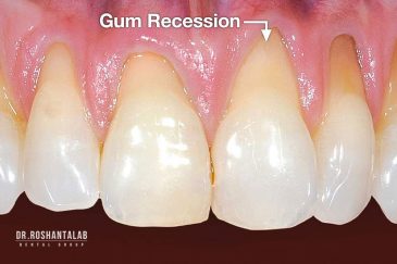 تحلیل لثه- علائم تا درمان آن