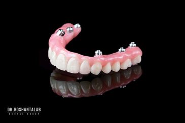 ایمپلنت کامل دندان با 4 پایه | عکس واقعی قبل و بعد بیمار