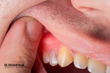 علائم عفونت دندان - بهترین روش درمان