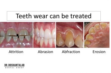 سایش دندان چیست، علل و درمان آن