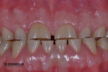 سایش دندان چیست، علل و درمان آن