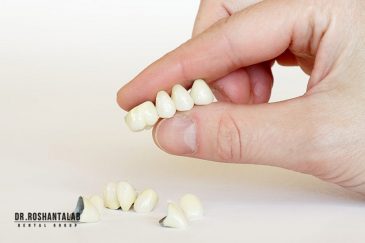 مراقبت های بعد از روکش دندان