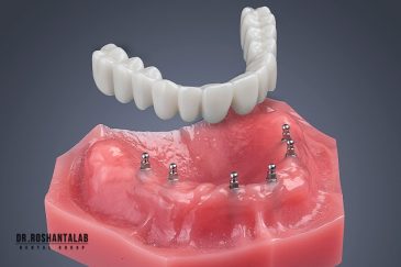 مینی ایمپلنت چیست و چند سال ماندگاری دارد؟